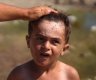 طفل من غزة مصاب بعدوى جلدية